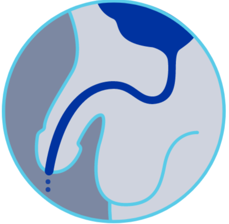 urinary leakage diagram