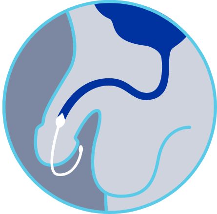 diagram showing Contino device stopping urinary leakage